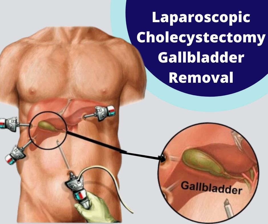 Laparoscopic Gallbladder Surgery Jeevan Shri Hospital 8405